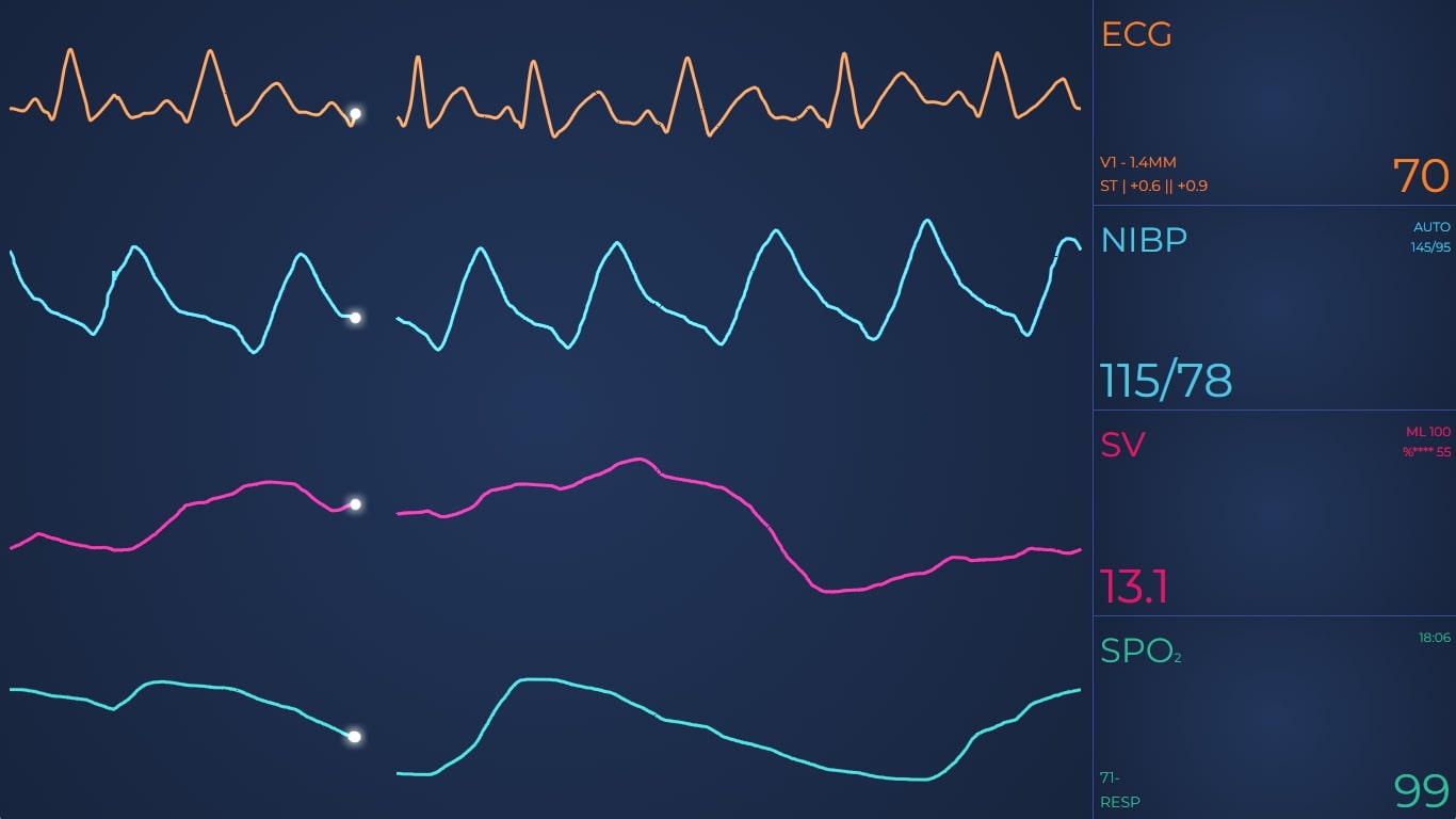 Medical ECG Chart used to display Cardiac Telemetry